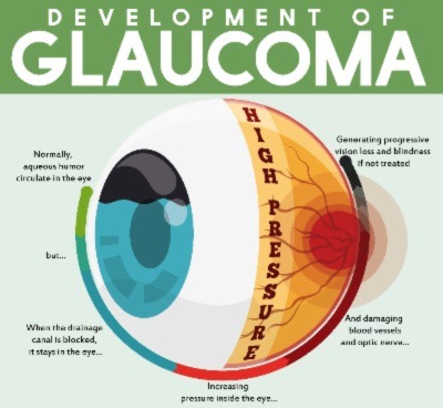 Development of Glaucome